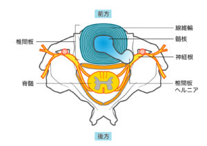 腰椎椎間板ヘルニア