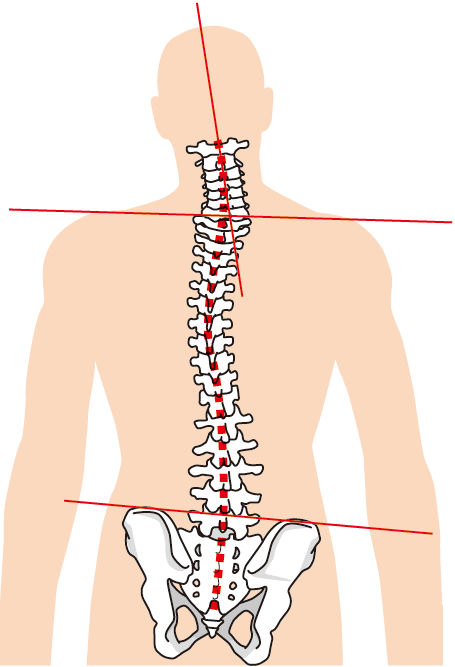背骨と骨盤の歪み
